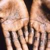 Monkeypox image